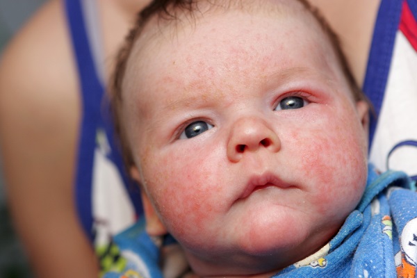 Các bệnh ngoài da thường gặp ở trẻ sơ sinh không nên coi thường - Chàm sữa