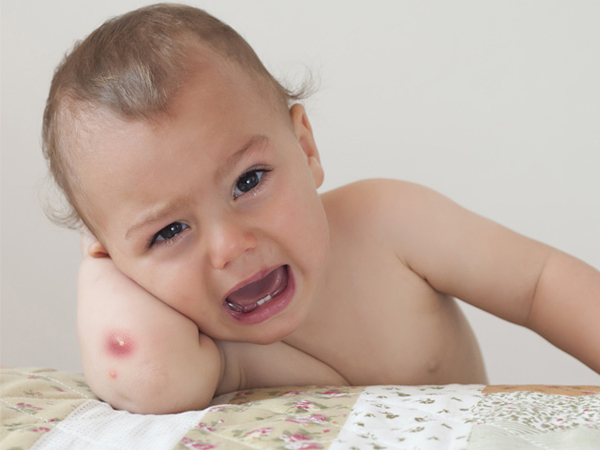 Các bệnh ngoài da thường gặp ở trẻ sơ sinh không nên coi thường - Mụn nhọt