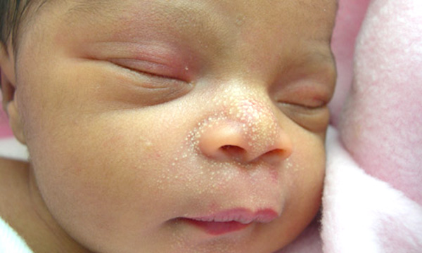 Các bệnh ngoài da thường gặp ở trẻ sơ sinh không nên coi thường - Hiện tượng hạt kê