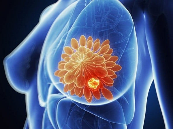 Tác dụng trà hoa cúc ngừa ung thư vú